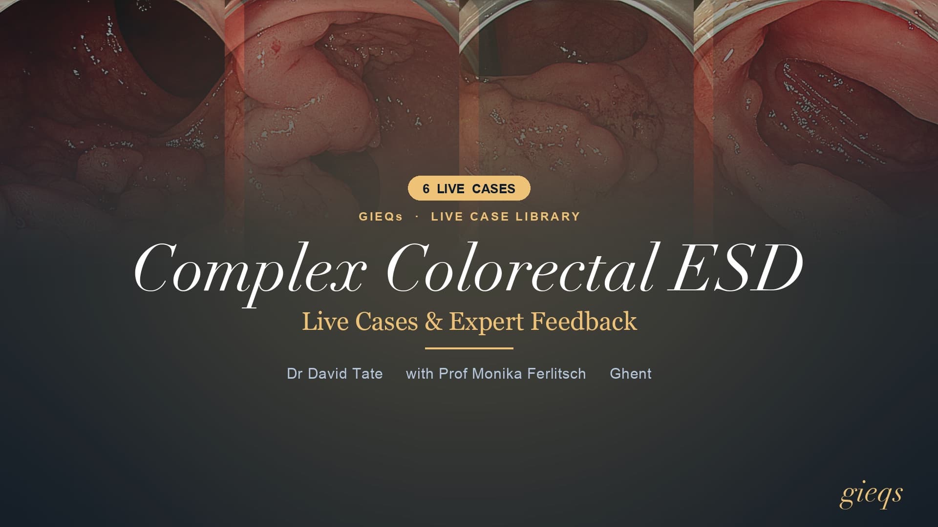 Complex Colorectal ESD — Live Cases & Expert Feedback