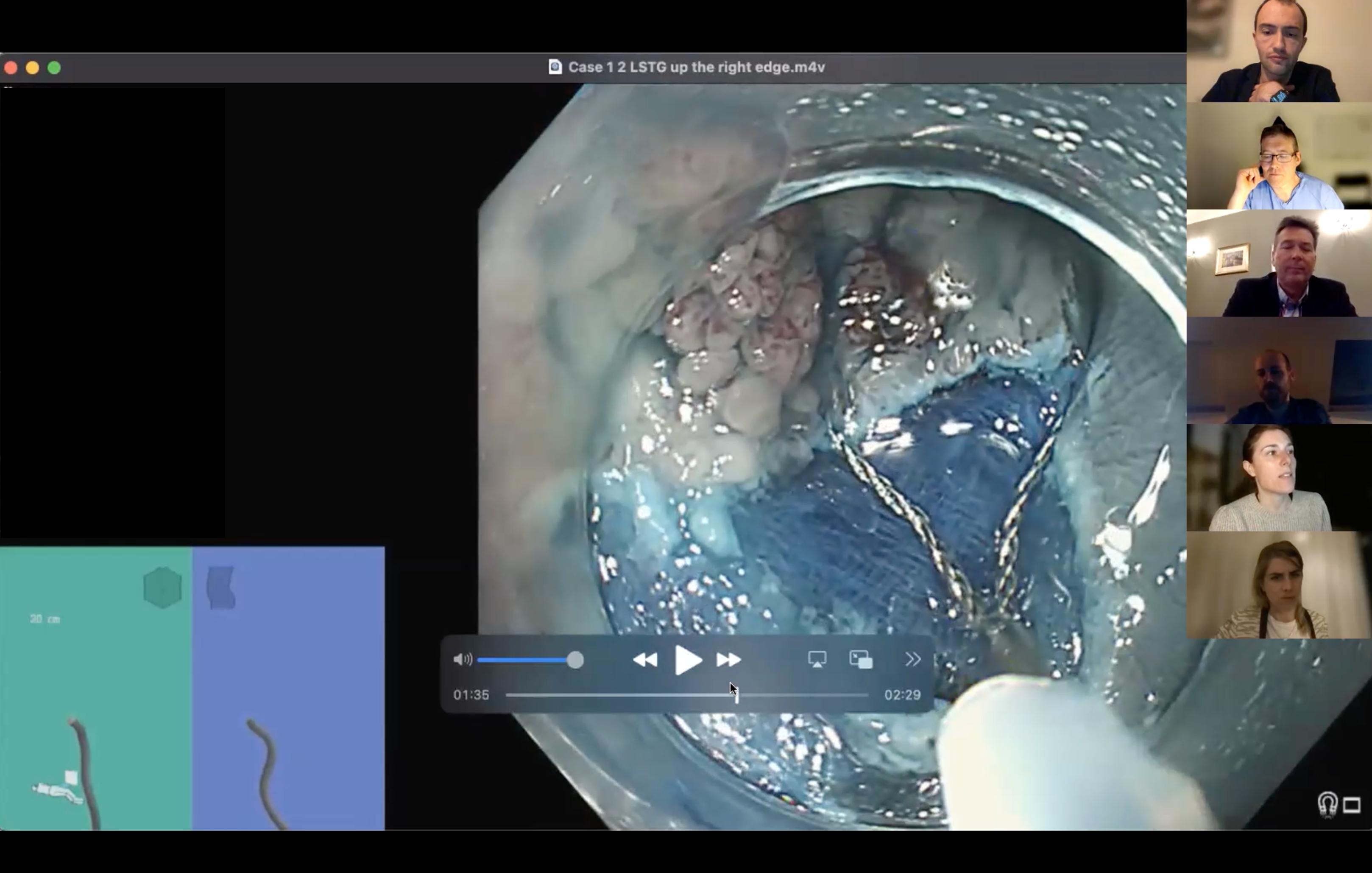 Gieqs Polypectomy webinar